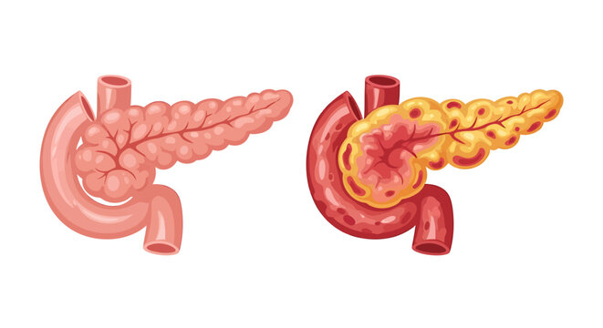 Human appendix and inflamed appendix.