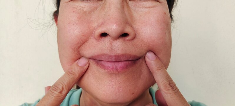 portrait the fingers holding the flabbiness and wrinkles, smile lines and scar beside the mouth, swelling and ptosis under the eyes, health care and beauty concept.