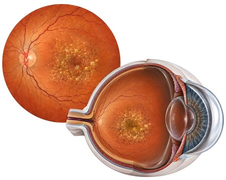 Age-Related Macular Degeneration (AMD) Eye Anatomy and Retinal Degeneration Medical Illustration