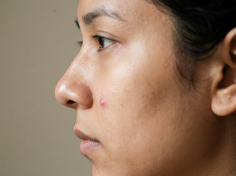 Close up profile of young woman's face showing a pimple on cheek skin human