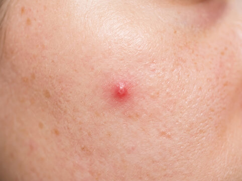 Extreme close up of human skin with a red inflamed acne pimple macro