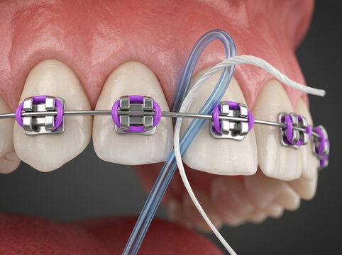 Detailed Dental Image Showing Metal Brackets, Archwire, and Elastic Ligatures for Orthodontic Treatment Advertising and Patient Guidance