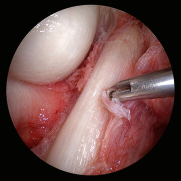 Intraoperative arthroscopic view of ankle surgery for chronic FHL tendonitis, endoscopic camera view showing tool debriding inflamed tissue around the tendon, blank template.