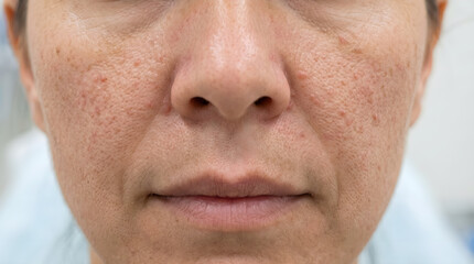 Naklejka premium Close Up of Facial Angiofibromas on Cheeks and Nose from Tuberous Sclerosis