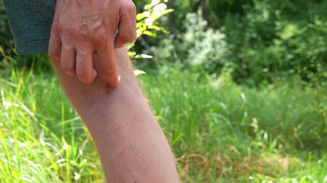 Applying cream to soothe an insect bite in nature