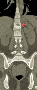 CT Scan of Lumbosacral Spine Showing Schmorl's Node