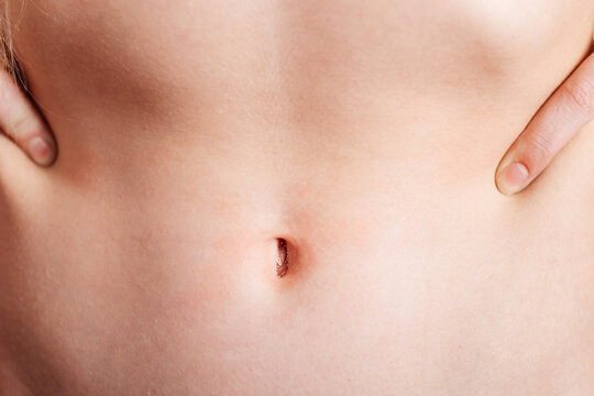 Close up of child abdomen with irritated navel and skin redness