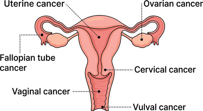 Medical Diagram of Gynecologic Cancer Types Showing Female Reproductive System Anatomy with Uterine Ovarian Cervical and Vaginal Tumor Locations Vector