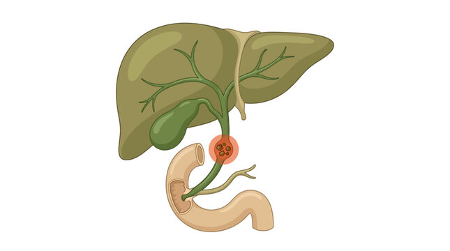Human Liver and Gallbladder Anatomy Vector Illustration with Gallstones Blocking the Common Bile Duct, Biliary Obstruction in the Digestive System, Duodenum Connection.