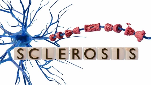 A 3D rendering of multipolar neuron with its dendrites branching out. Letter tiles spell out the word "SCLEROSIS",a damaged myelin sheath wraps around an axon extending.