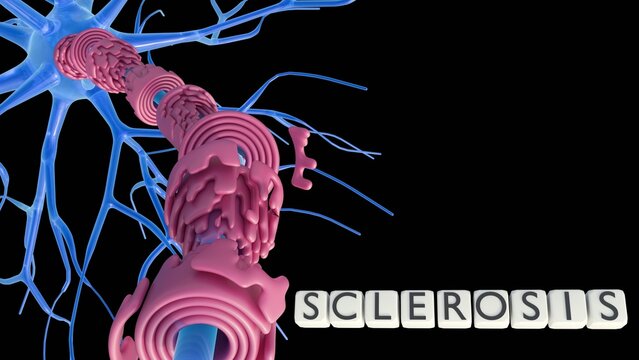 A 3D rendering of multipolar neuron with its dendrites branching out. Letter tiles spell out the word "SCLEROSIS",a damaged myelin sheath wraps around an axon extending.