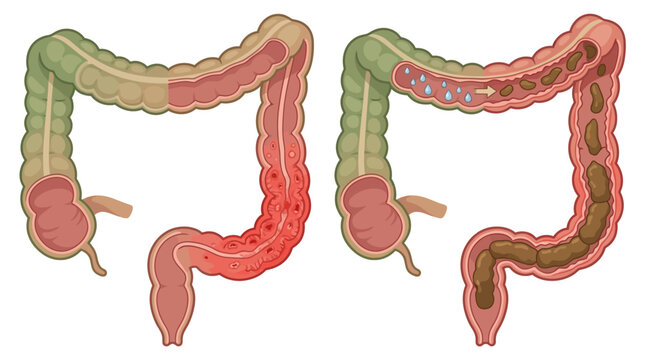 Medical illustration of the human colon showing comparative cross-sections of intestinal inflammation and the physiological process of stool formation with water absorption.