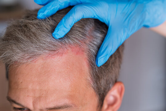 Man with psoriasis on his scalp inspects the affected area while wearing blue medical gloves in a clinical environment with blurred background