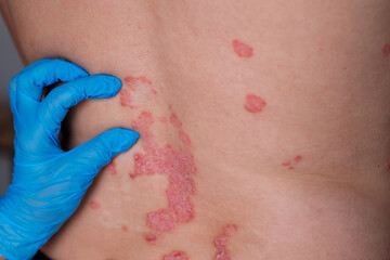 Fototapeta premium Close-up view of psoriasis lesions on a person's back, with a gloved hand gently touching the affected skin in a medical environment