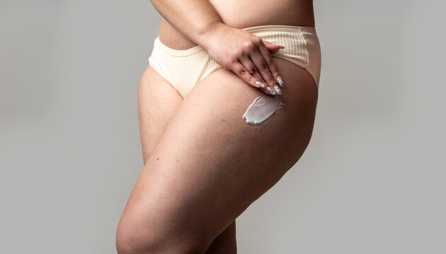 Cellulite on legs with fat and skin dimples. Anti cellulite cream on hips and thigh. Cellulite cream for skin and fat care. Natural cellulite on thigh with cream.