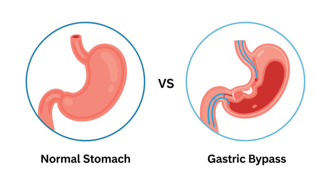Medical comparison diagram showing a normal human stomach versus the result of a gastric bypass surgery for weight loss treatment.