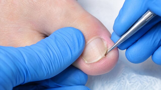Podiatrist Treating Ingrown Toenail with Professional Medical Tool