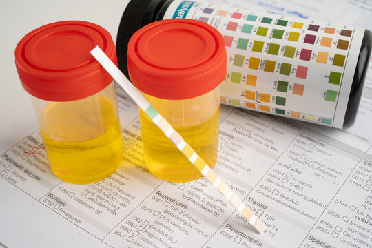 Urinalysis, urine cup with reagent strip pH paper test and comparison chart in laboratory.
