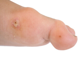 Fototapeta premium Wart on man's foot. Verruca plantaris on the foot.