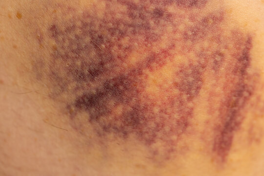 Purple hematoma on human skin, close up