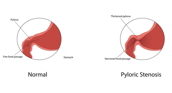 Pyloric stenosis vector illustration