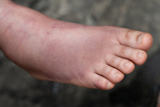 Swollen Foot After Cast Removal of Metatarsal Fracture