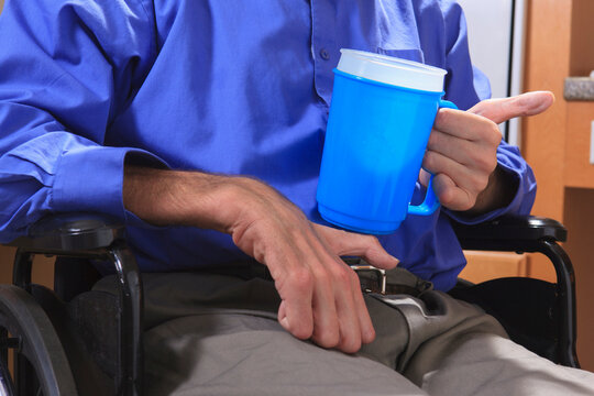 Man with Friedreich's Ataxia holding a cup of water with his deformed hands