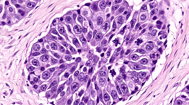Microscopic view of abnormal cell growth forming a cluster in tissue