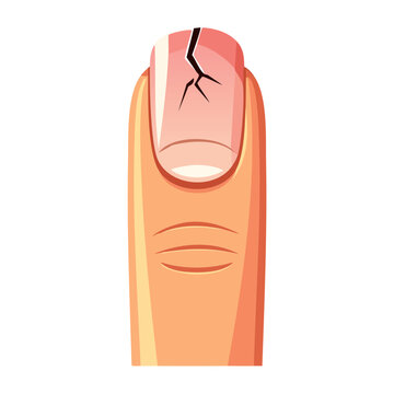 Illustration of a broken fingernail on a finger