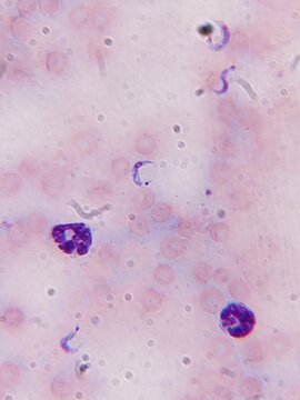 Trypanosoma cruzi Trypomastigotes and Amastigotes in Blood Smear Under Giemsa Stain