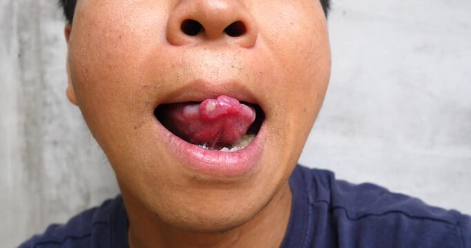 A man with (Canker Sores), Mouth ulcer, (Aphthous Ulcers), Mouth sores caused by allergies., Oral Diseases: Concepts