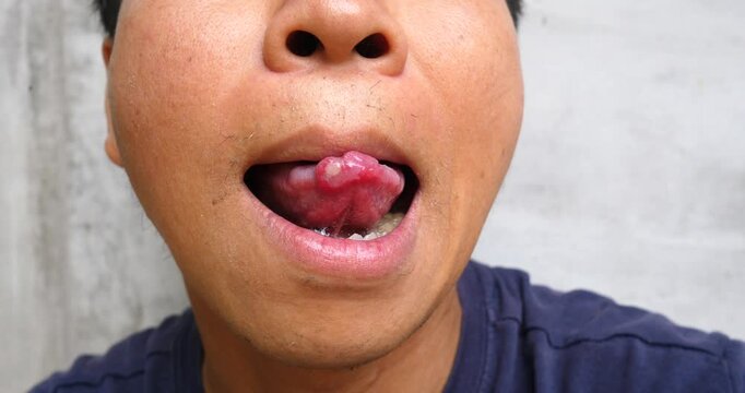 A man with (Canker Sores), Mouth ulcer, (Aphthous Ulcers), Mouth sores caused by allergies., Oral Diseases: Concepts
