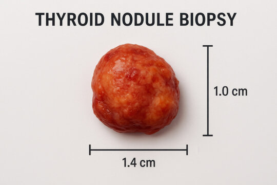 Medical training visual showing serious clinical view of thyroid nodule biopsy specimen positioned on white background with measurement indicator for surgical oncology analysis