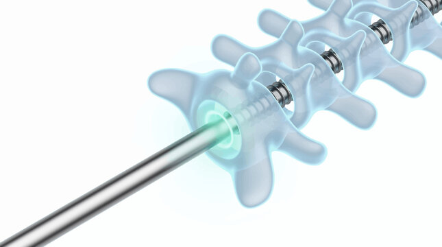Advanced 3D rendering of spinal fusion surgery, illustrating the precision and technology involved in modern medical bone fixation procedures for musculoskeletal health
