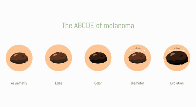 ABCDE rule for melanoma detection showing warning signs of skin cancer