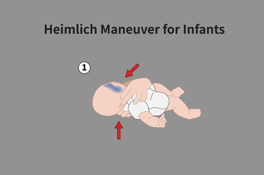 Heimlich Maneuver for Infants illustration 01