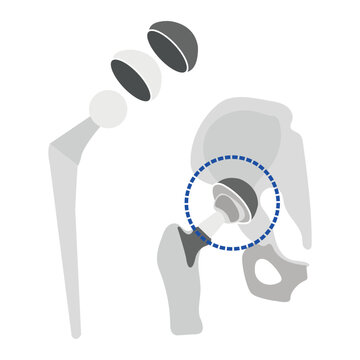 Orthopedic hip prosthesis diagram with joint replacement