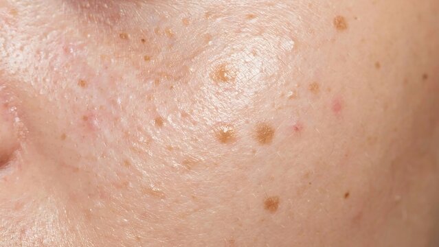 Close up of skin with freckles and moles on face skin with brown spots