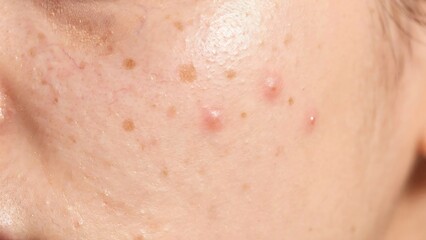 Fototapeta premium Close up of acne on a person's cheek skin with freckles and blemishes on face