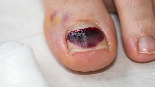 Close up of a bruised and bleeding toenail with surrounding skin irritation and inflammation on a white surface