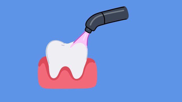 animation light curing composite filling hardening process in tooth