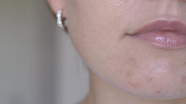 Close-up footage of woman applying hydrocolloid acne patch on chin with visible blemish and redness. Realistic skincare treatment concept for cosmetic brands and dermatology services.