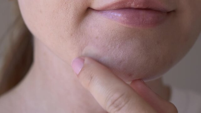 Close-up of transparent pimple patch covering acne spot on female chin. Beauty and skincare concept focused on spot treatment, clean skin and overnight blemish care.