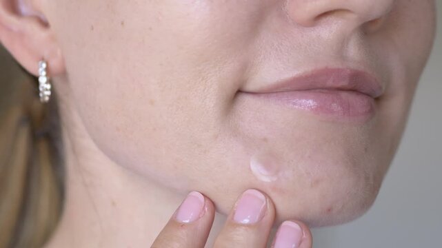 Close-up of transparent acne patch covering inflamed blemish on female chin. Visual concept for overnight pimple treatment and effective skincare recovery solutions.