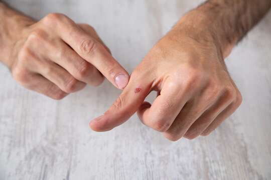 Caucasian man showing callus on hand.