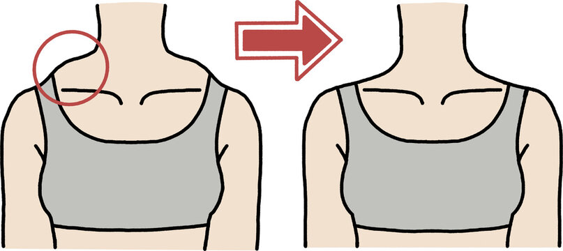 Trapezius muscle reduction and straight shoulder line before and after body correction illustration