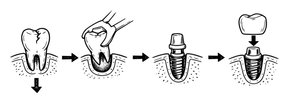 Dental implant process illustrating tooth extraction, screw implant placement, and artificial crown attaching to restore dentistry