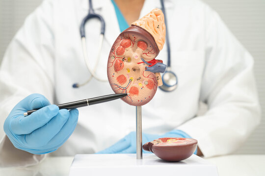 Chronic kidney disease, Asian woman with model for treatment urinary system, urology, Estimated glomerular filtration rate eGFR.