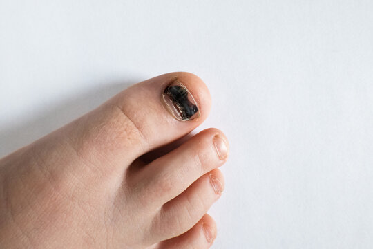 A blackened bruised big toe (subungual hematoma) on a childs foot shot over a white paper background.