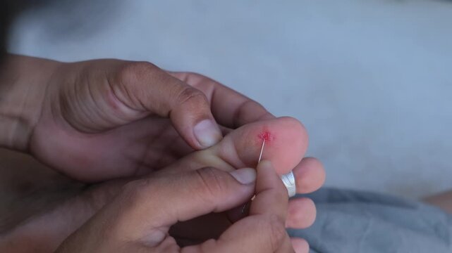Close-up of a person using a needle to treat a small wound or splinter on their toe